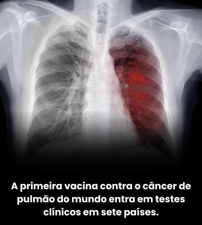 A primeira vacina contra o câncer de pulmão do mundo entra em testes clínicos em sete países.