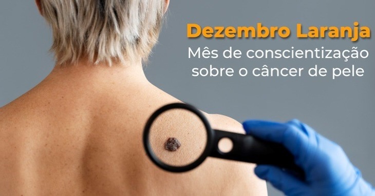 Dezembro Laranja reforça cuidados contra o câncer de pele