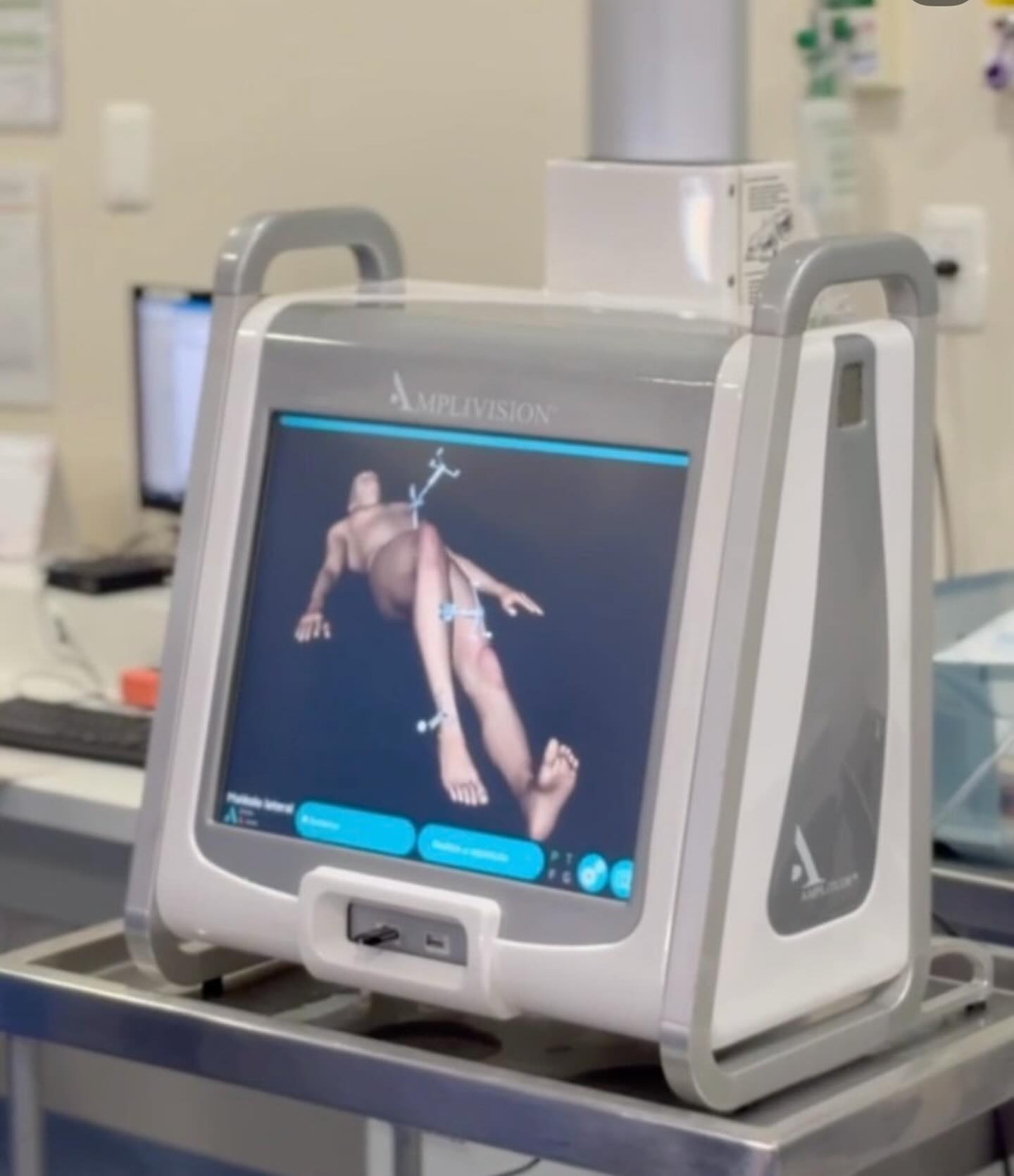 Hospital Estrela realiza primeira cirurgia de joelho com auxílio robótico