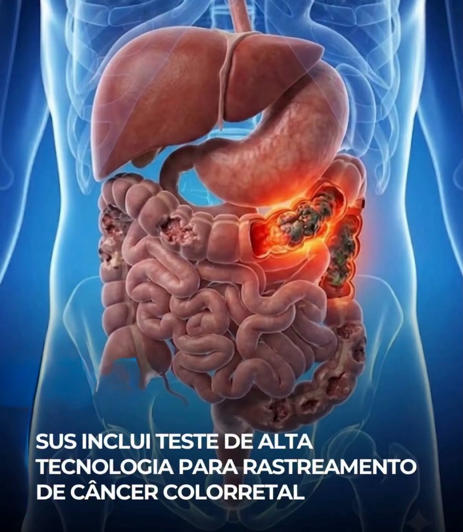 SUS INCLUI TESTE DE ALTA TECNOLOGIA PARA RASTREAMENTO DE CÂNCER COLORRETAL